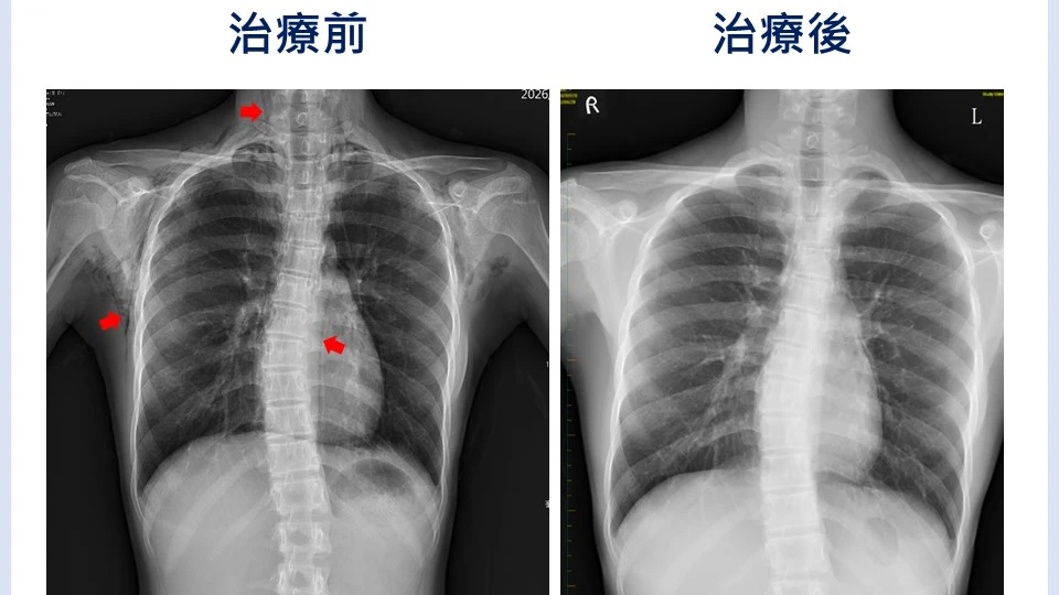 13歲男童深呼吸後胸痛、喘！竟是罕見縱膈腔氣腫　醫曝4大警訊